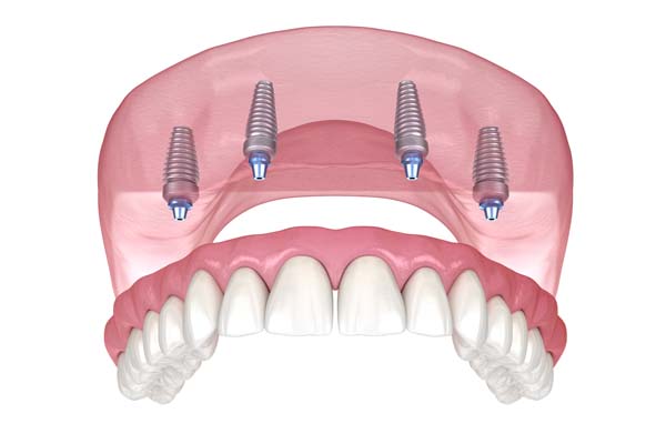 A Step By Step Guide To All On   Implants