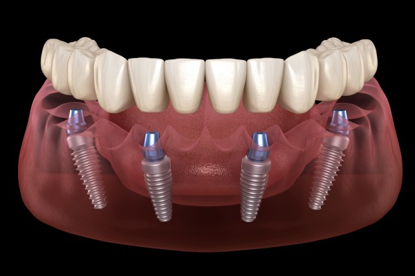 All On 4 Dental Implants Houston, TX