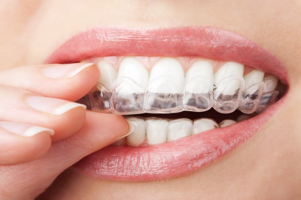 How Clear Aligners Are Used To Straighten Teeth