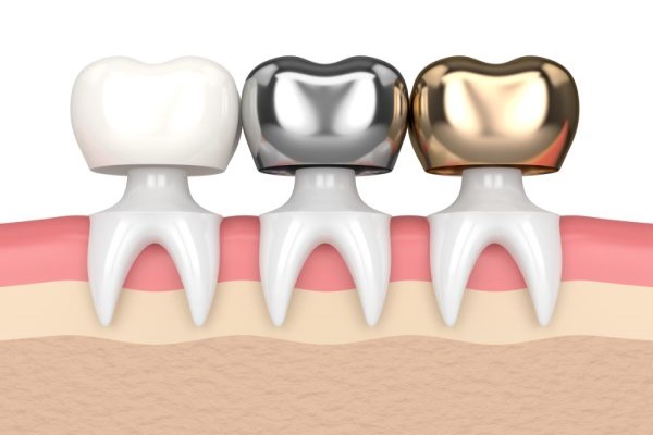 Types of Dental Crown Material 