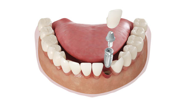 Do Dental Implants Look And Feel Natural?