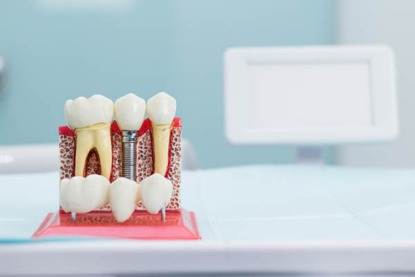 When Would A Family Dentist Recommend Dental Implants?
