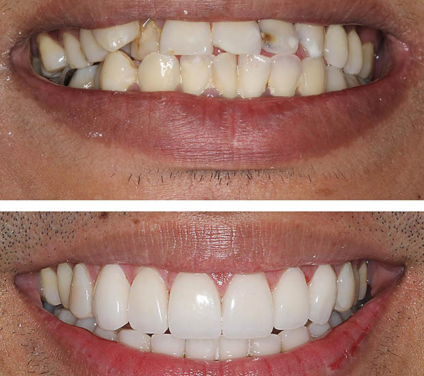 Houston Dental Veneers and Dental Laminates