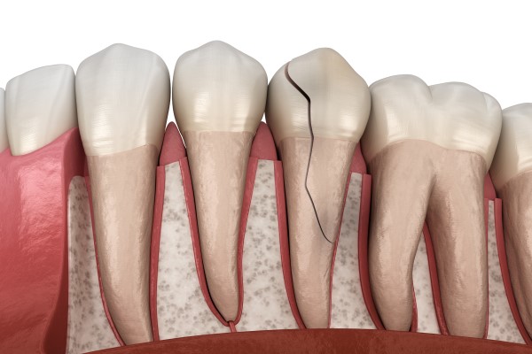 Dental Treatment Options To Repair A Cracked Tooth