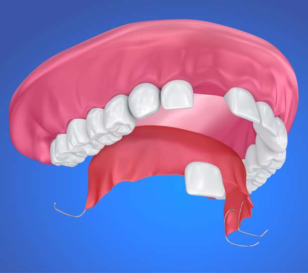 Houston Partial Denture for One Missing Tooth