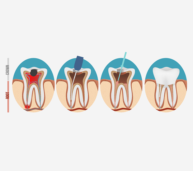 Houston Root Canal Treatment