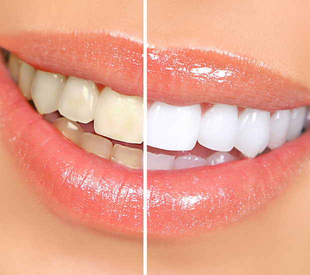 Houston Teeth Whitening